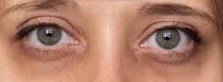 how to get rid of dark circles